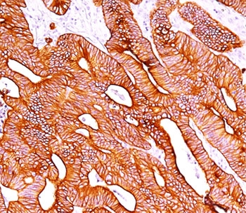 IHC staining of colon carcinoma with pan Cytokeratin antibody cocktail AE1 + AE3.