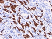 IHC staining of human liver with Hep Par 1 antibody (clone OCH1E5). HIER: boil tissue sections in pH 9 10mM Tris with 1mM EDTA for 20 min and allow to cool before testing.