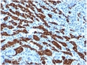 IHC staining of human hepatocellular carcinoma with Hep Par 1 antibody (clone OCH1E5). HIER: boil tissue sections in pH 9 10mM Tris with 1mM EDTA for 20 min and allow to cool before testing.