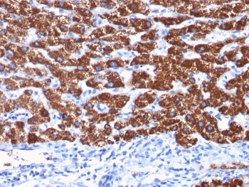 IHC staining of human hepatocellular carcinoma with Hep Par 1 antibody (clone OCH1E5). HIER: boil tissue sections in pH 9 10mM Tris with 1mM EDTA for 20 min and allow to cool before testing.~