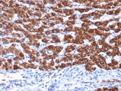 IHC staining of human hepatocellular carcinoma with Hep Par 1 antibody (clone OCH1E5). HIER: boil tissue sections in pH 9 10mM Tris with 1mM EDTA for 20 min and allow to cool before testing.