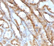 IHC testing of FFPE human renal cell carcinoma with Mitochondrial antibody (clone MTC719).