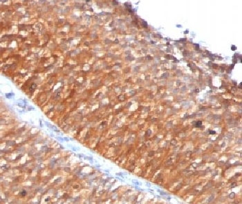 IHC testing of FFPE human bladder carcinoma with Mitochondrial antibody (clone MTC719).~
