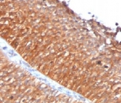 IHC testing of FFPE human bladder carcinoma with Mitochondrial antibody (clone MTC719)
