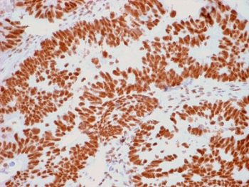 IHC staining of FFPE human colon carcinoma with Nucleoli Marker antibody. HIER: boil tissue sections in pH6, 10mM citrate buffer, for 10-20 min and allow to cool before testing.