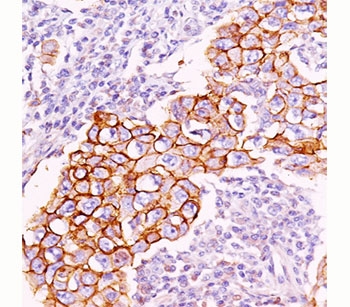 IHC staining of breast carcinoma with phosphotyrosine antibody (PY20). Note cell surface and cytoplasmic staining.~