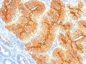 IHC staining of FFPE human colon carcinoma with TAG-72 antibody (clone B72.3).
