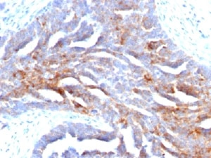 IHC staining of human ovarian carcinoma with TAG-72 antibody (clone B72.3).~