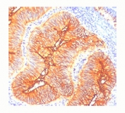 IHC staining of human colon cancer with TAG-72 antibody (clone CA72/733).