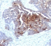 IHC testing of human ovarian carcinoma with TAG-72 antibody (clone CA72/733).
