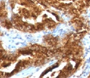 IHC testing of human prostate carcinoma with TAG-72 antibody (clone CA72/733).~