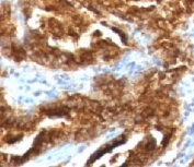 IHC testing of human prostate carcinoma with TAG-72 antibody (clone CA72/733).