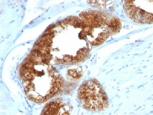 IHC staining of human prostate carcinoma with TAG-72 antibody cocktail (B72.3 + CA72/733).~