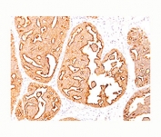 Epithelial Marker Antigen antibody IHC testing of formalin-paraffin human breast cancer tissue (clone MUC1/967).