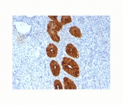Epithelial Marker Antigen antibody IHC testing of formalin-paraffin human endometrial cancer tissue (clone MUC1/967).