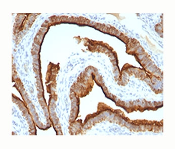 Epithelial Marker Antigen antibody IHC testing of formalin-paraffin human ovarian cancer tissue (clone MUC1/967).~