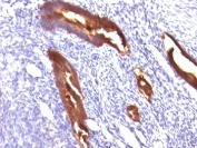 Formalin-fixed, paraffin-embedded human endometrial carcinoma stained with EMA antibody (MUC1/845).