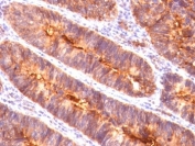 Formalin-fixed, paraffin-embedded human colon carcinoma stained with EMA antibody (MUC1/845).