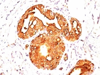 Formalin-fixed, paraffin-embedded human breast carcinoma stained with EMA antibody (MUC1/845).
