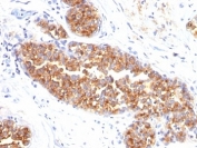 Formalin-fixed, paraffin-embedded human breast carcinoma stained with MUC1 / EMA antibody (MUC1/845).