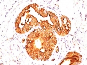 IHC staining of FFPE human breast carcinoma with MUC-1 antibody. HIER: boil tissue sections in pH 9 10mM Tris with 1mM EDTA for 10-20 min and allow to cool before testing.