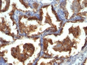 IHC staining of FFPE human lung carcinoma with MUC-1 antibody. HIER: boil tissue sections in pH 9 10mM Tris with 1mM EDTA for 10-20 min and allow to cool before testing.