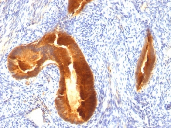 IHC staining of FFPE human endometrial carcinoma with MUC-1 antibody. HIER: boil tissue sections in pH 9 10mM Tris with 1mM EDTA for 10-20 min and allow to cool before testing.~