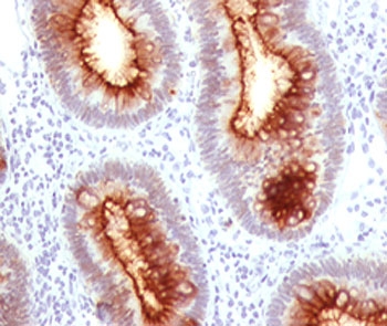FFPE staining of human colon carcinoma with CEA antibody C66/1030.