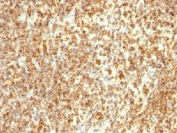 IHC testing of CD20 antibody and human lymphoma tissue. HIER: boil tissue sections in pH 9 10mM Tris with 1mM EDTA for 20 min and allow to cool before testing.