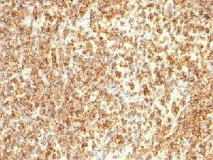 IHC testing of CD20 antibody and human lymphoma tissue. HIER: boil tissue
