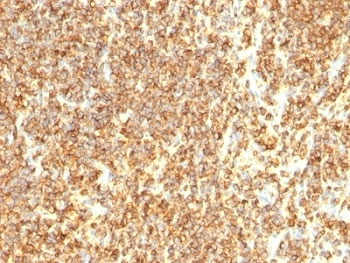 IHC testing of CD20 antibody and FFPE human lymphoma tissue (clone SPM494).~