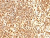 IHC testing of CD20 antibody and FFPE human lymphoma tissue (clone SPM494).