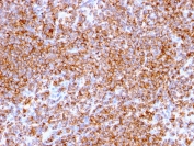 IHC staining of FFPE human lymphoma tissue with CD20 antibody (clone IGEL/773).