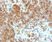 IHC testing of CD45RB antibody and FFPE human lymphoma (PTPRC/1132).