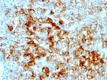 IHC: Formalin-fixed, paraffin-embedded human renal cell carcinoma stained with anti-Cadherin 16 antibody (clone SPM594).~