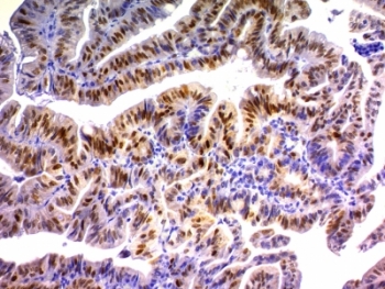 IHC analysis of formalin-fixed, paraffin-embedded human colon carcinoma stained with p21 antibody (clone DCS-60.2).~