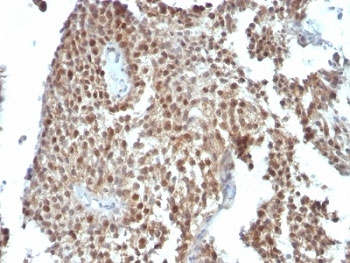 IHC: Formalin-fixed, paraffin-embedded human colon carcinoma stained with anti-p21 antibody (clone SPM306).~