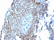 IHC: Formalin-fixed, paraffin-embedded human bladder carcinoma stained with p21 antibody (clone CIP1/823).