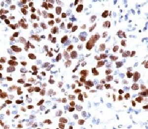 IHC: Formalin-fixed, paraffin-embedded human lung squamous cell carcinoma (SCC) stained with p21 antibody (clone CIP1/823).~