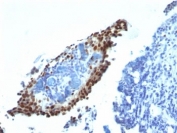 IHC: Formalin-fixed, paraffin-embedded bladder carcinoma stained with p21 antibody (clone HJ21).