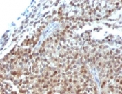 IHC: Formalin-fixed, paraffin-embedded human bladder carcinoma stained with p21 antibody cocktail (clones CIP1/823 + DCS-60.2).