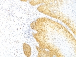 IHC: Formalin-fixed, paraffin-embedded human cervical cancer stained with p27Kip1 antibody (clone KIP1/769).