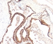 IHC: Formalin-fixed, paraffin-embedded human prostate cancer stained with p27Kip1 antibody (clone KIP1/769).