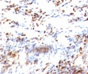 IHC: Formalin-fixed, paraffin-embedded human colon carcinoma stained with p27Kip1 antibody (clone KIP1/769).
