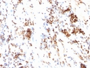 IHC: Formalin-fixed, paraffin-embedded human colon carcinoma stained with p27 antibody (DCS-72.F6)