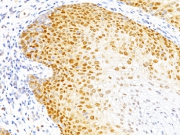 IHC: Formalin-fixed, paraffin-embedded human cervical cancer stained with p27 antibody (DCS-72.F6)~