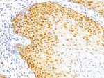 IHC: Formalin-fixed, paraffin-embedded human cervical cancer stained with p27 antibody (DCS-72.F6)