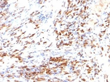 IHC: Formalin-fixed, paraffin-embedded human colon carcinoma stained with p27 antibody (DCS-72.F6 + KIP1/769)