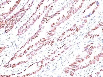 IHC analysis of formalin-fixed, paraffin-embedded human colon carcinoma stained with p57 antibody (KP10).~