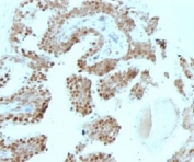 IHC: Formalin-fixed, paraffin-embedded human prostate carcinoma stained with p57Kip2 antibody (SPM308).